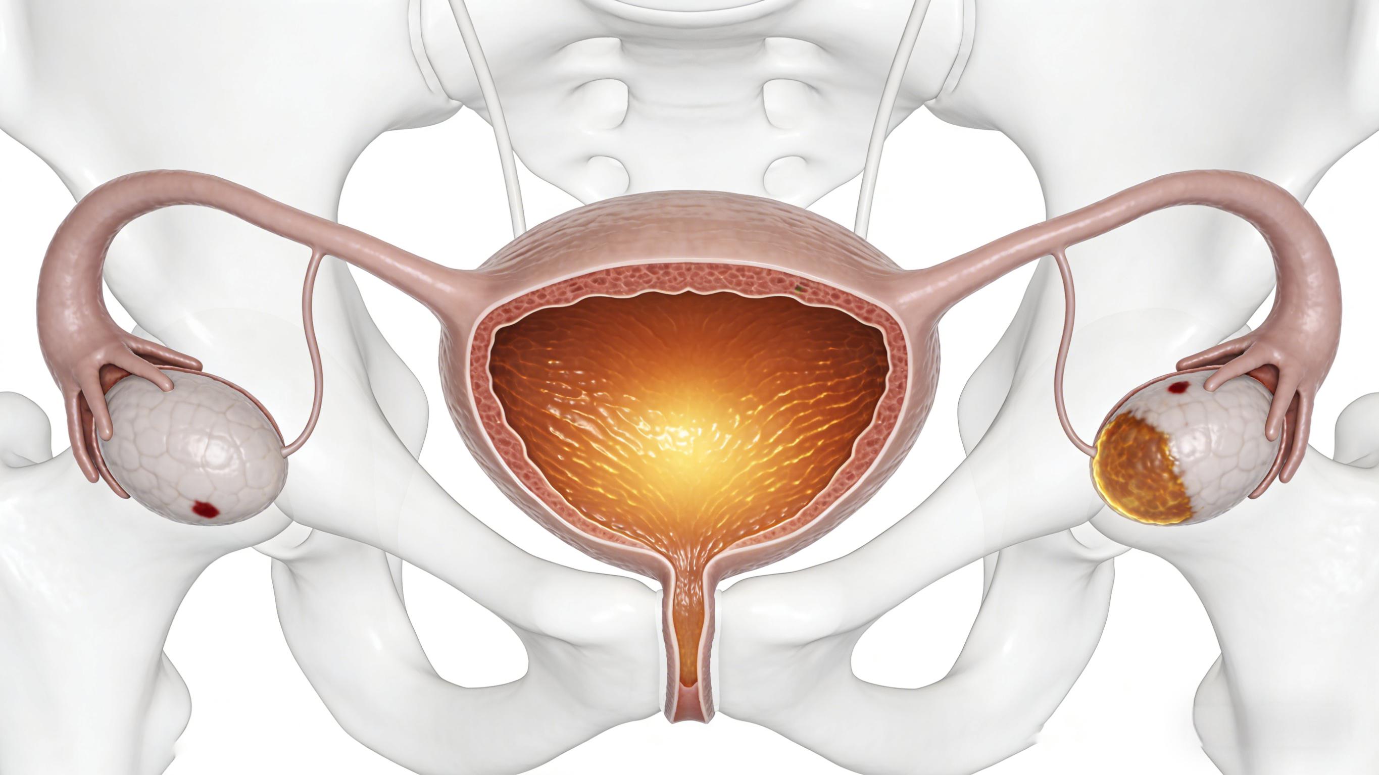 Bladder cancer